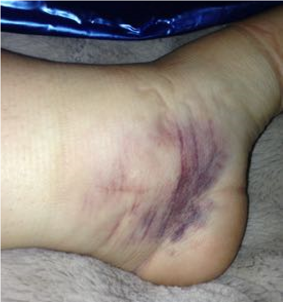 Surface image of patient’s bruised right ankle.