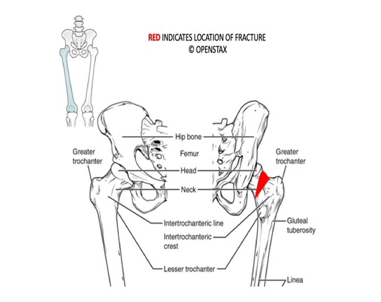 Diagram of fractured neck of the femur bone.