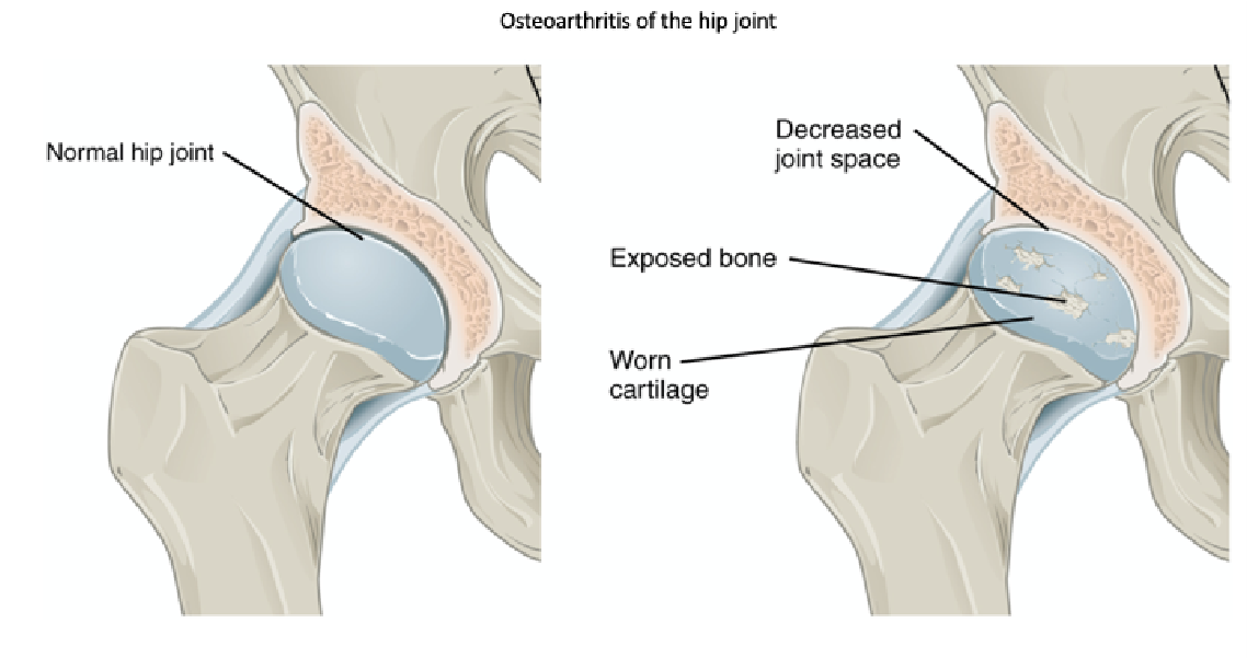 Head of the femur and its articulation with the pelvis showing the presence of exposed bones due to osteoarthritis.