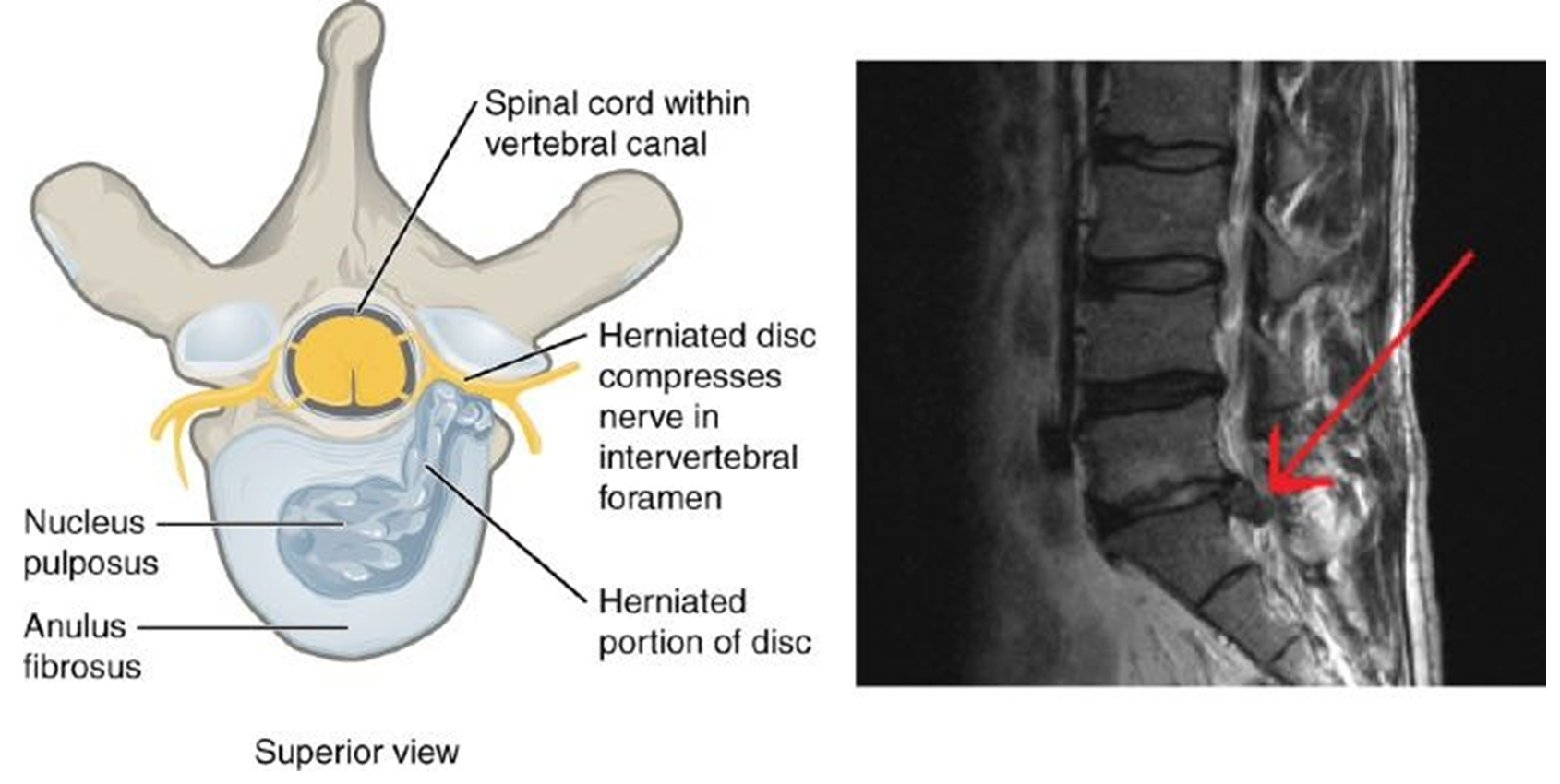 Diagram of the vertebrae and spinal cord of a herniated disk and an MRI image of the sagittal view of the spinal cord – the red arrow marks the location of the herniated disc.