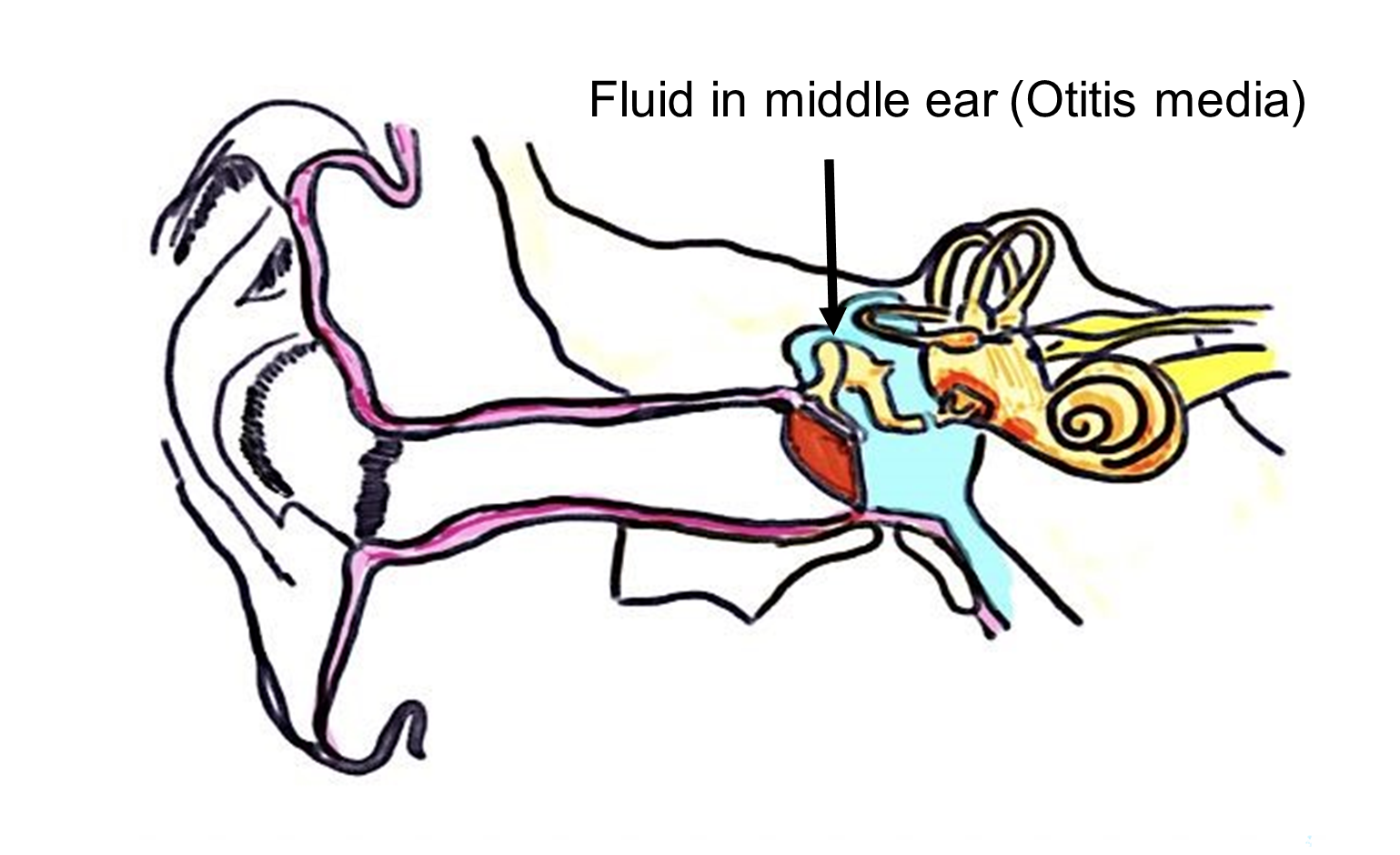 Image of human ear with otitis media (fluid in the middle ear), colored in blue.