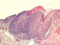 Biopsy of acute squamous cell carcinoma.