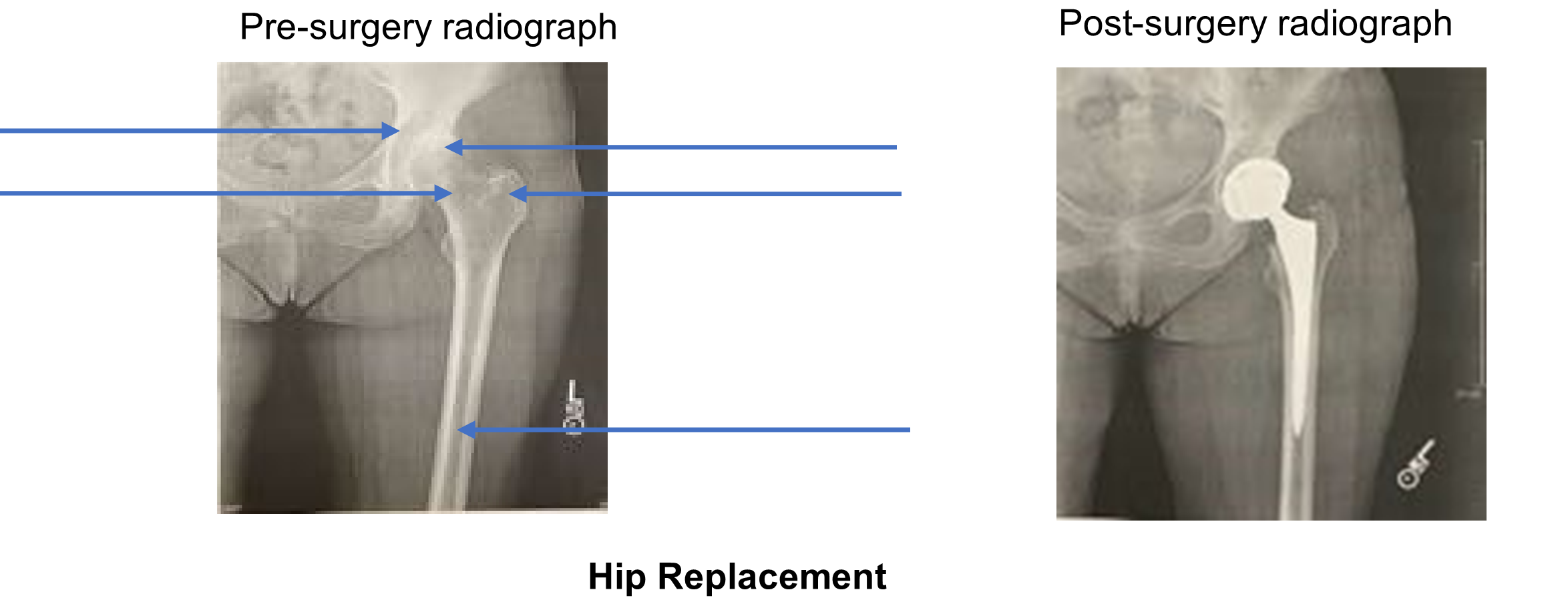 Hip replacement radiograph.