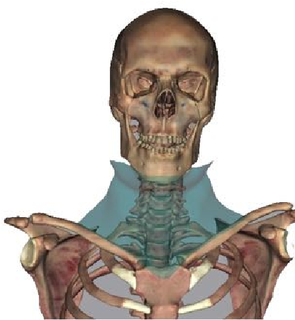 Image of Platysma muscle.